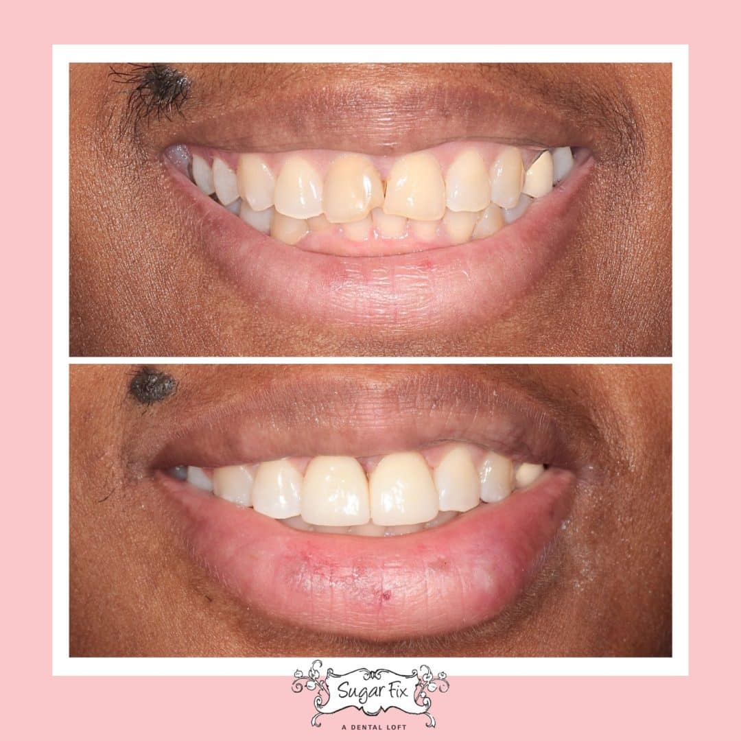 Porcelain Veneers Before And After Veneers In Lakeview