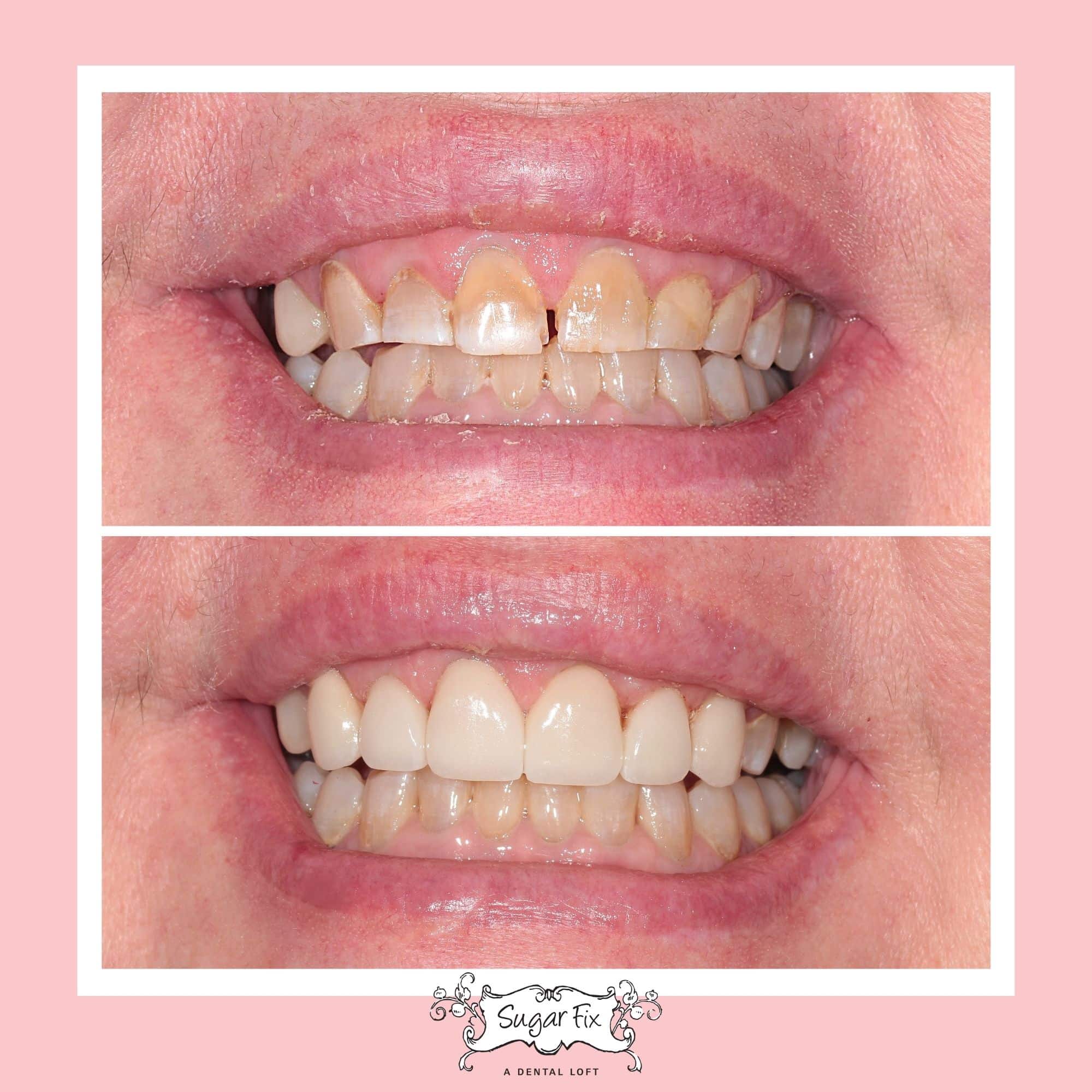 Porcelain Veneers Before And After Veneers In Lakeview