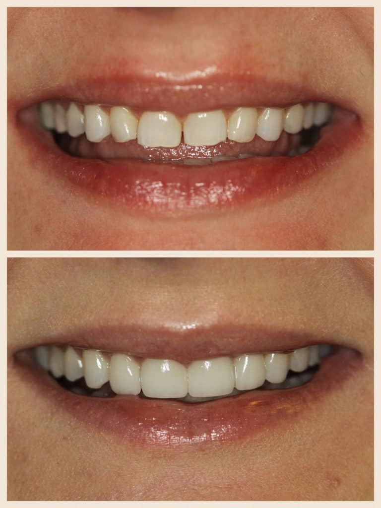 Porcelain Veneers Before and After | Veneers in Lakeview