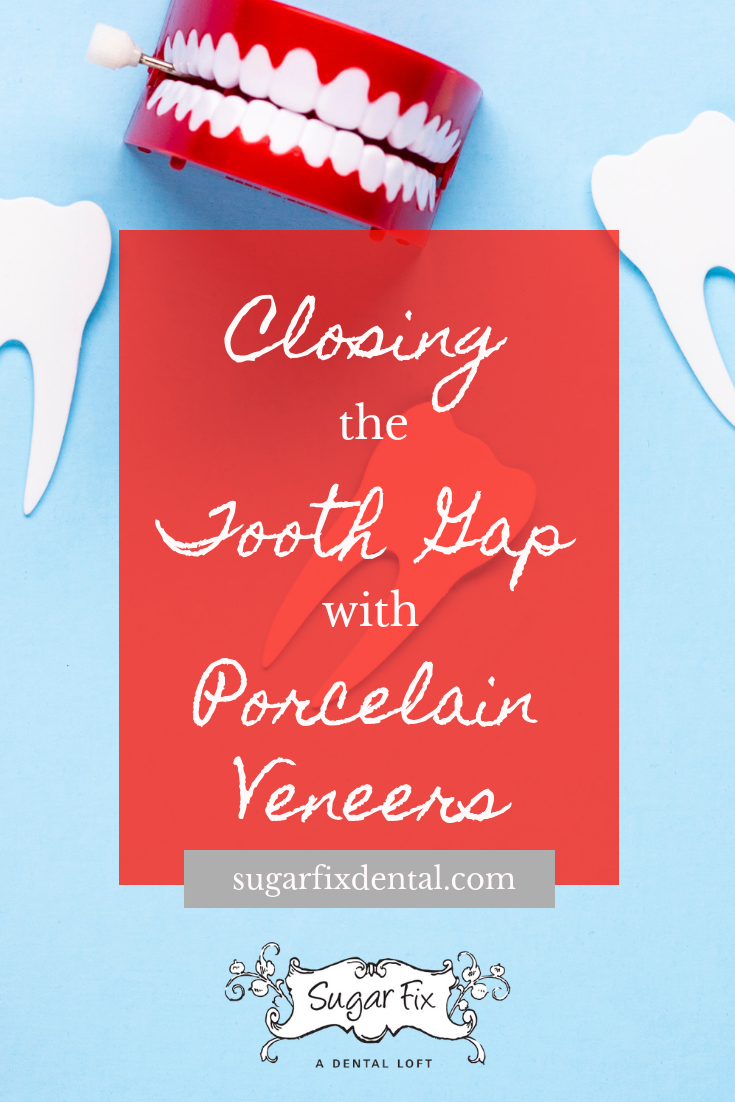 Tooth Gap Blog Post