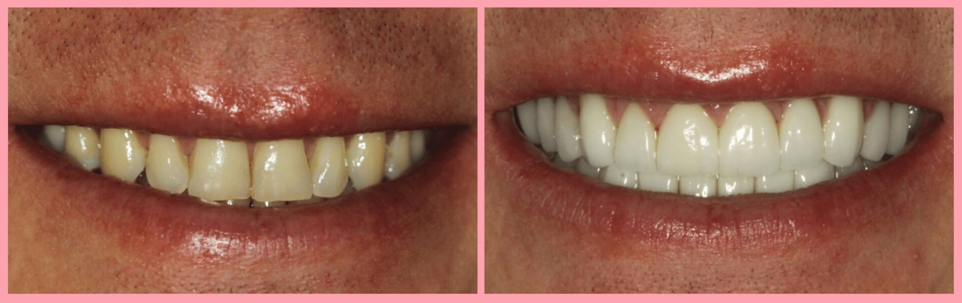 Porcelain Veneer Makeovers #1