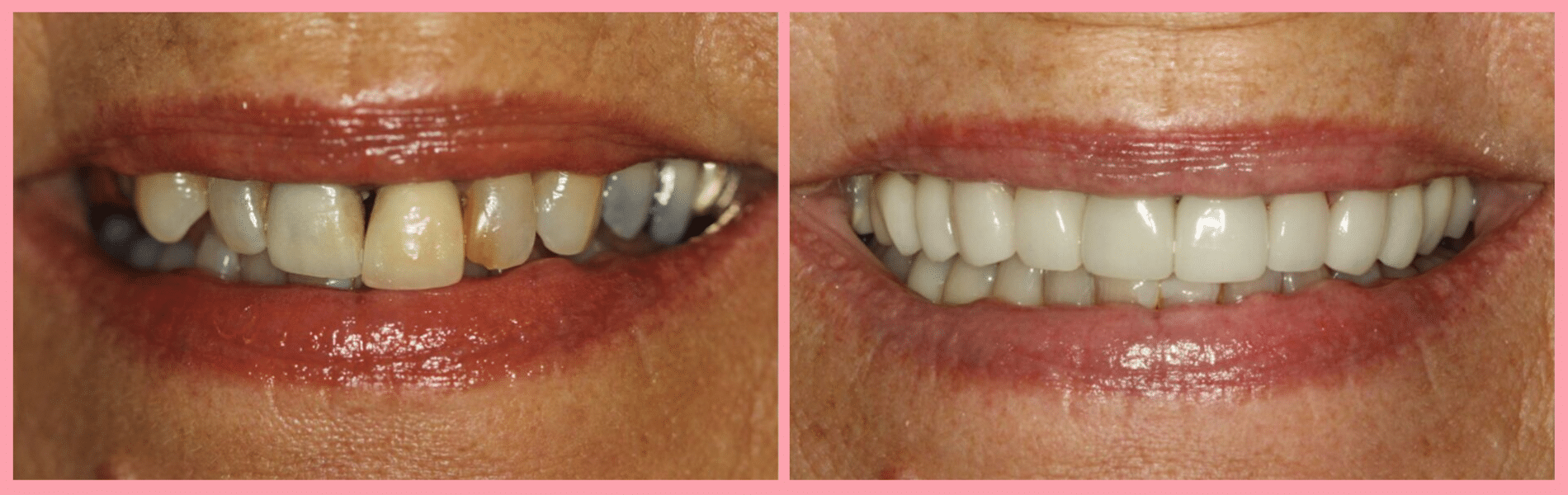 Porcelain Veneer Makeovers #2