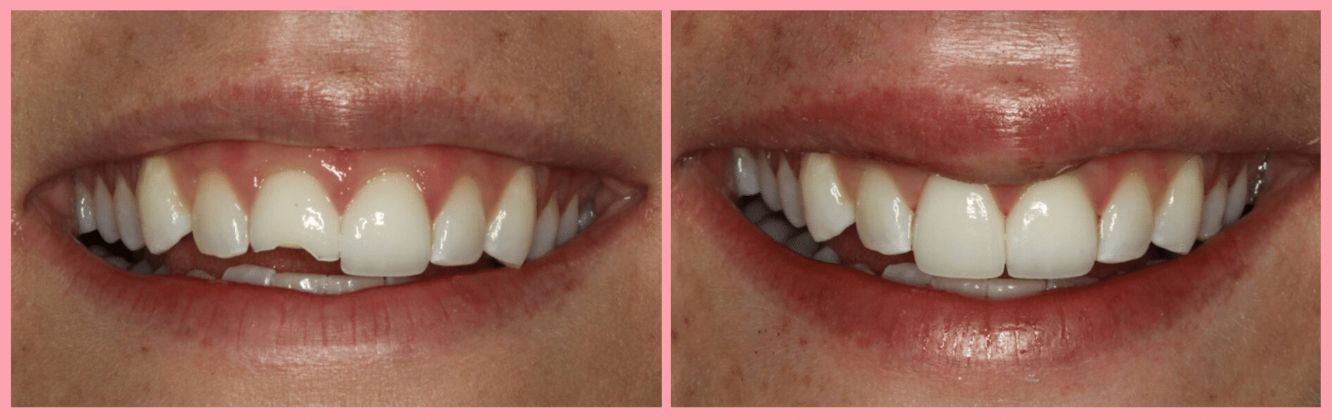 Porcelain Veneer Makeovers #3