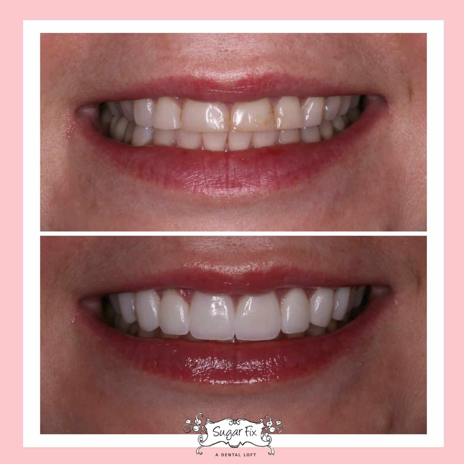 Porcelain Veneers Before And After | Veneers In Lakeview