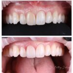 dark tooth porcelain veneers whitening teeth