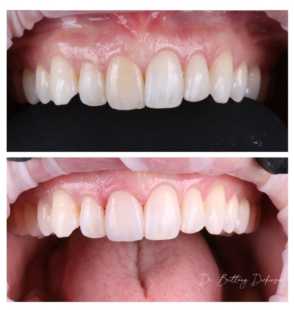 dark tooth porcelain veneers whitening teeth