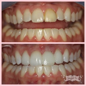 before and after of discolored crown