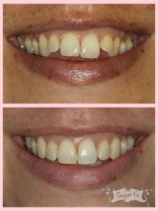 Before and after of Invisalign
