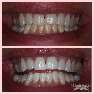 Zoom whitening