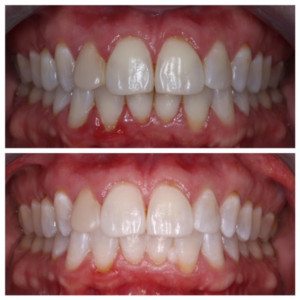 Zoom Whitening Before & After // Sugar Fix Dental//january