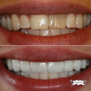 porcelain veneers or dental bonding