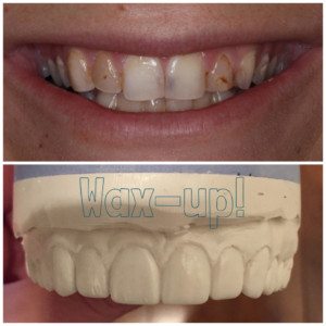 dental wax up