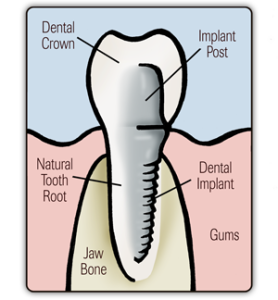 cost of dental implants