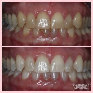zoom whitening results