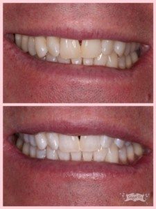 whitening before the holidays