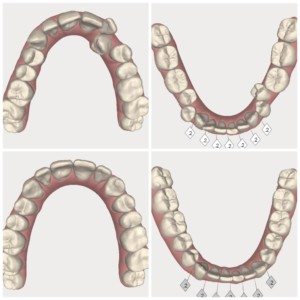 Sugar Fix Dental Loft, invisalign work