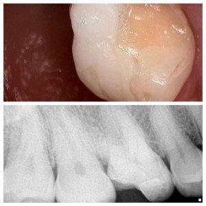 Broken Tooth / Dr. Jessica Emery / Sugar Fix Dental Loft