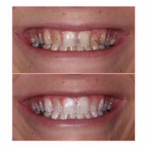 sugar fix dental loft//porcelain restorations