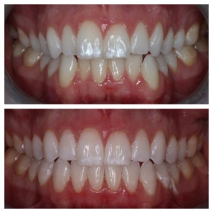 sugarfixdentalloft//porcelain restorations