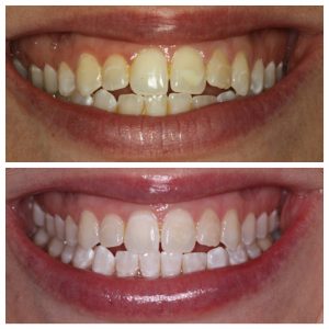 sugar fix dental loft// white spots