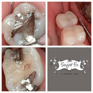 Before and after cerec