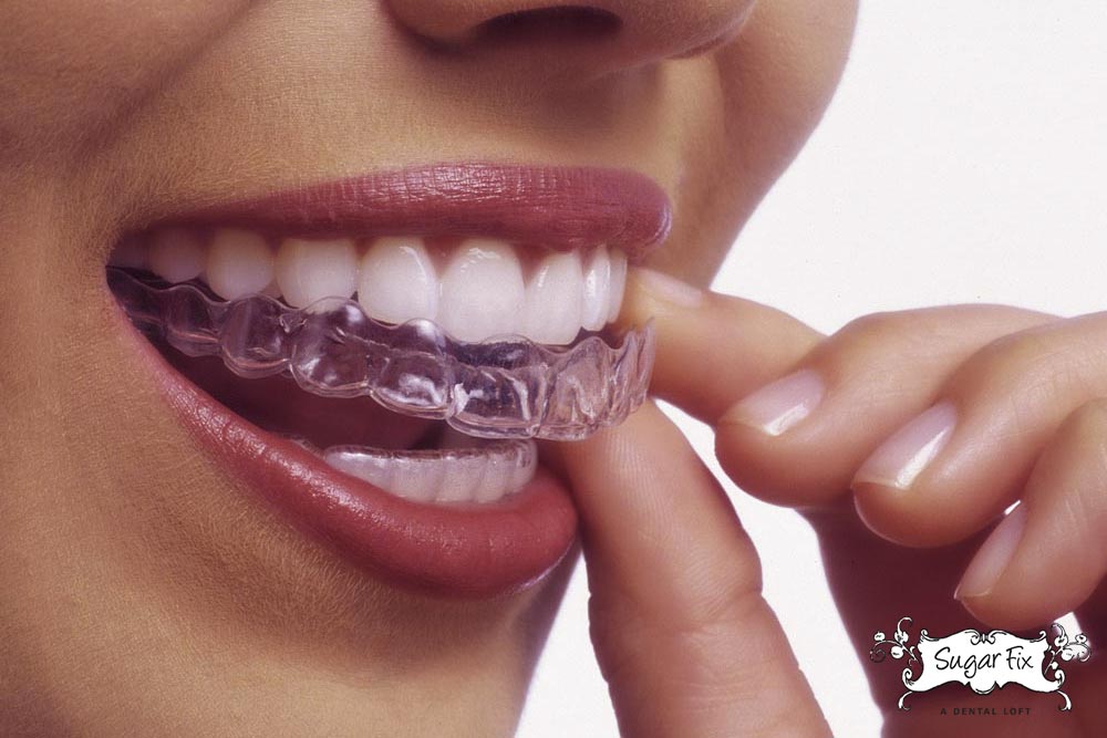Invisalign-The-first-days-of-trays