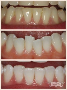 Lower teeth crowding fixed with Invisalign 10 Express