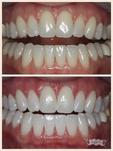zoom whitening before and after