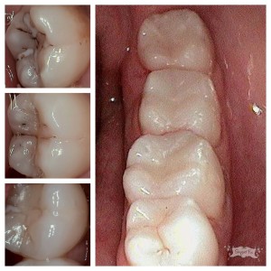 Teeth with decay vs. teeth made by cerec