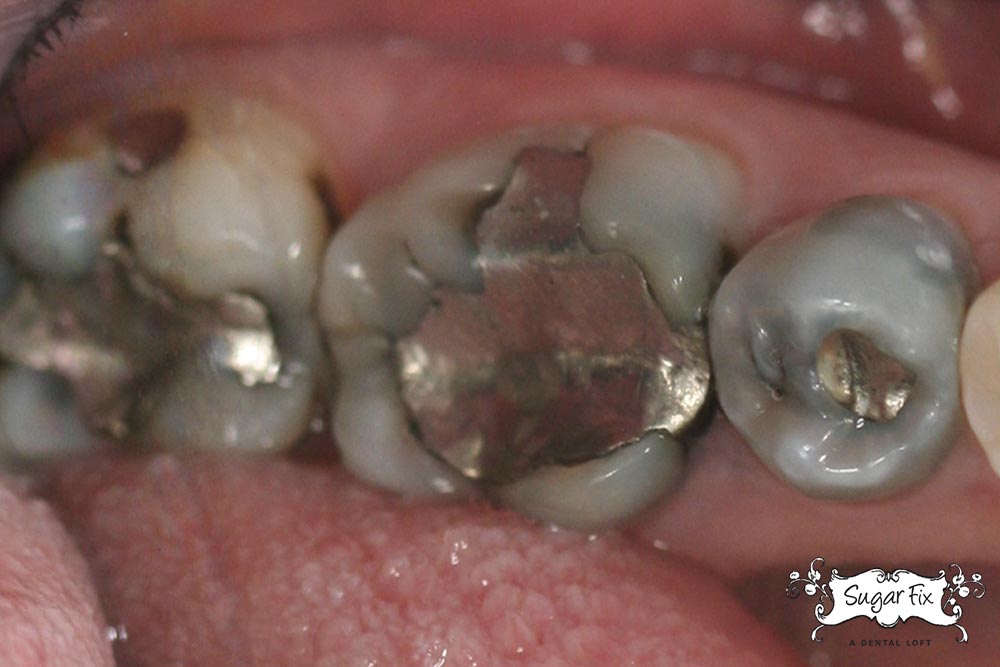 Still-have-old-silver-mercury-fillings-in-your-teeth-Replace-them