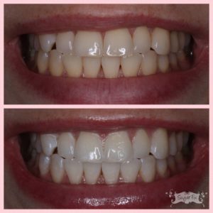 before and after whitening