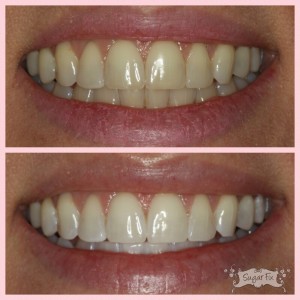 whitening