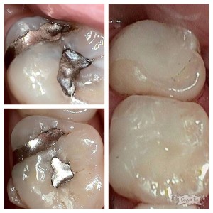 Before with Silver fillings, after with Cerec fillings