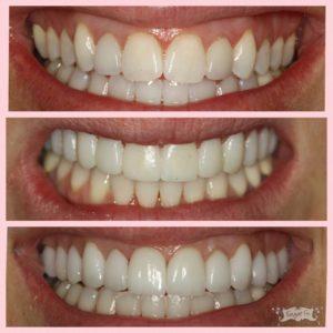 Veneers before and after