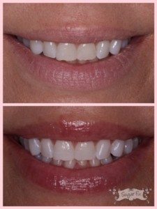whiten sensitive teeth