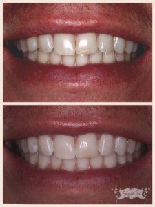 whitening before the holidays