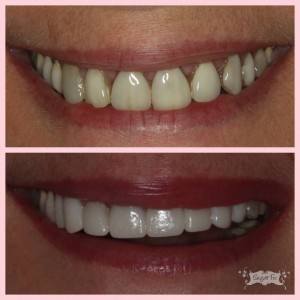 old veneers vs temporaries