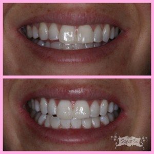 zoom whitening