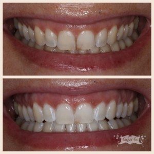 Zoom Whitening