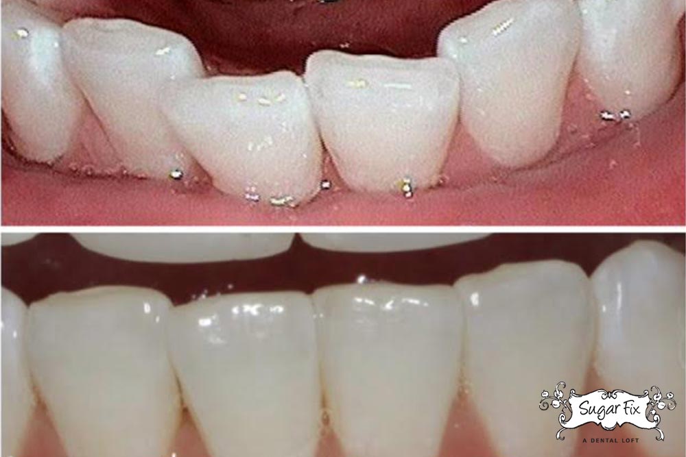 Invisalign Update: Ashley - Sugar Fix Dental Loft