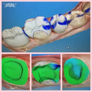 Cerec Design