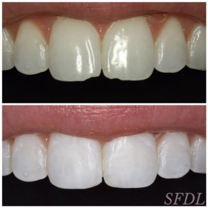 Before and after of anterior bonding to correct chipped teeth