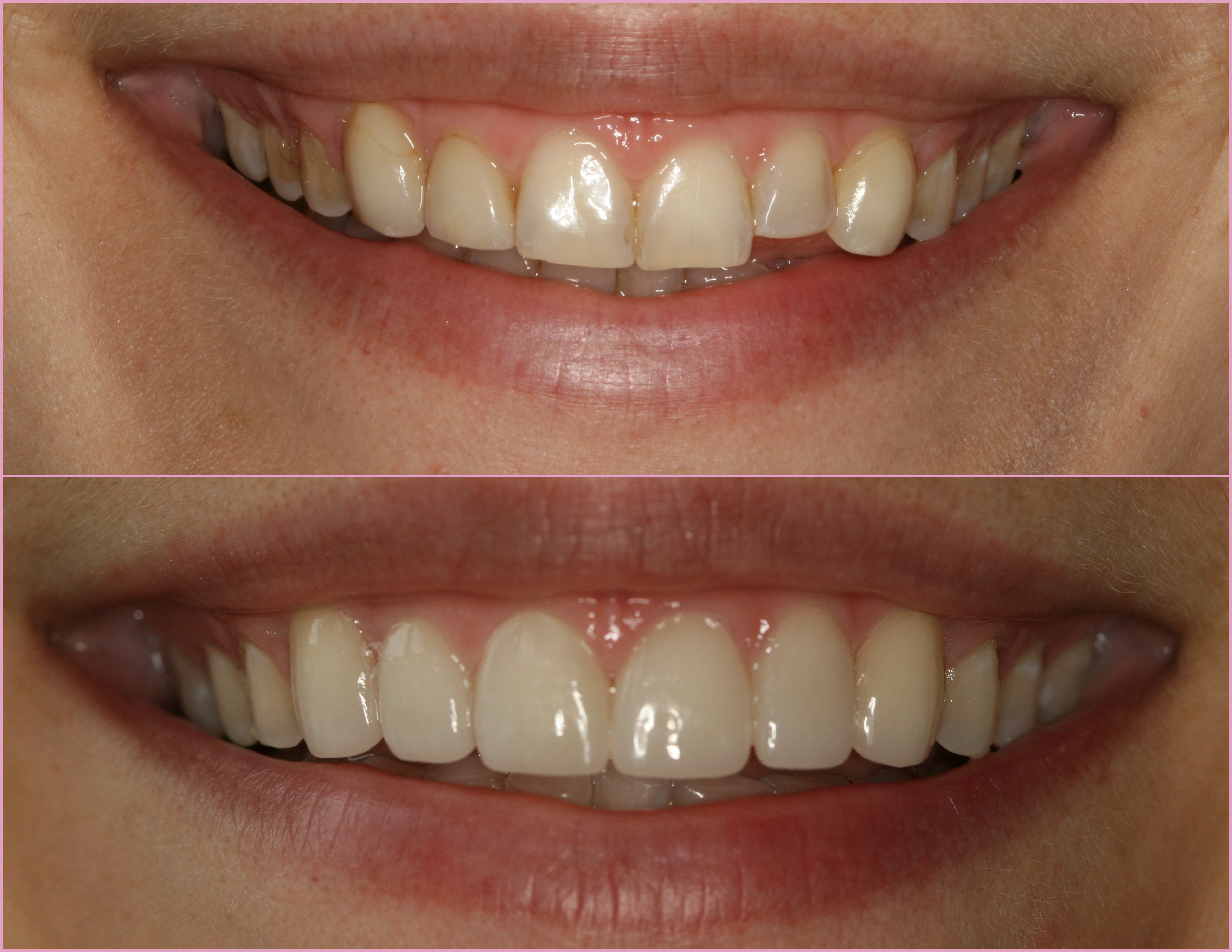 Dental Veneer Preparation Types at Salvador Earley blog