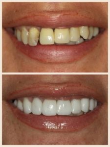 Porcelain Veneers // Before & After // Dr. Jessica Emery // Sugar Fix Dental Loft // Lakeview Dentist