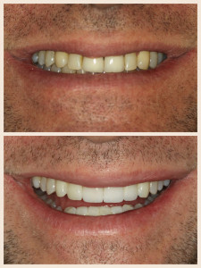 Porcelain Veneers // Before & After 2 // Dr. Jessica Emery // Sugar Fix Dental Loft // Lakeview Dentist